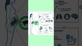 Sarcoidosis affects pregnancy mrcogcourses duringpregnancy mrcogpart2 mrcogpart3 sarcoidosis [upl. by Killam]