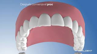 Estética Dental  Contorneado  Vitaldent [upl. by Wanyen43]