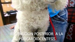 PERICARDIOCENTESIS  CITOLOGIA CON CELULAS NEOPLASICAS [upl. by Anstice]