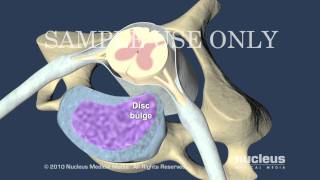 Cervical Disc Herniation [upl. by Naujek]