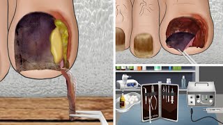 ASMR Ingrown Toenail removal treatment animation relax  리얼한 내성 발톱 케어 애니메이션 [upl. by Muhcan]