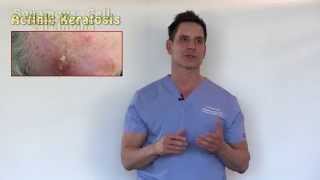 PreCancers or Actinic Keratosis Treatment Options With Dr Timothy Jochen [upl. by Morgen]