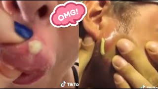 Satisfying Blackhead Removal Compilation  Best Techniques for Clear Skin [upl. by Eibmab]