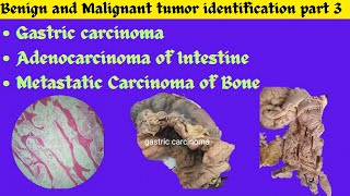 Gastric carcinoma Adenocarcinoma of Intestine Metastatic tumor of Bone identification Patho OSPE [upl. by Ros708]