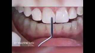 Composite Veneers step by step  All the Secrets [upl. by Naehgem645]