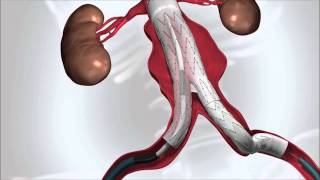 Abdominal Aortic Aneurysm [upl. by Caldwell]