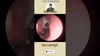 귀지형 콧물 부비동염 축농증 비염 코청소 이비인후과 rhinorrhea rhinitis sinusitis asmr ENT entdoctor [upl. by Lazaro]