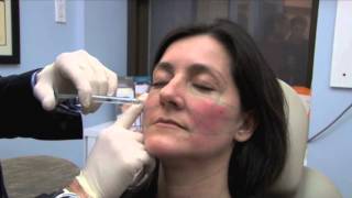 Dr Pearlman Demonstrates Juvéderm Voluma™ XC [upl. by Matelda]