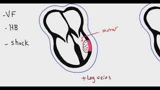 Systemic pathology 6  CVS  myocardial infarction  DRSAMEH GHAZY [upl. by Meerak]