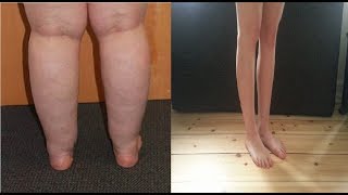 how to get rid of cankles without surgery [upl. by Hansel109]