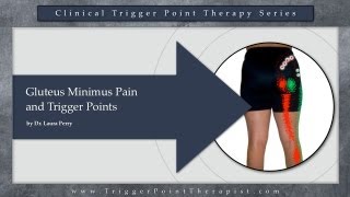 Gluteus Minimus Pain and Trigger Points [upl. by Knick]