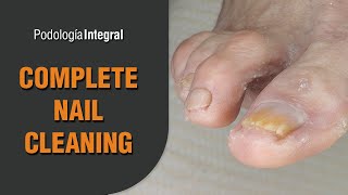 Complete nail cleaning Podología Integral Integral Podology [upl. by Donell]