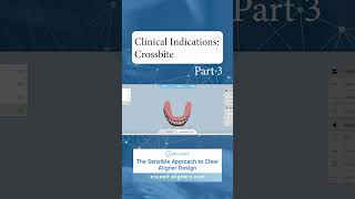 Clinical Indications Crossbite Part 3 [upl. by Eromle]