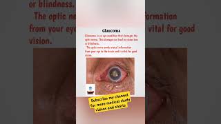 GlaucomaFreeMedicalEducationld3sfglaucomamedicalnursingmbbsviralshortsviralmedicalvideos [upl. by Munafo]