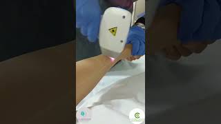 épilation laser Fès laser Arrazi [upl. by Nnylharas]