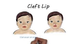 Cleft lip and Cleft Palate Surgery V1 [upl. by Eliam379]