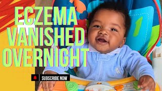 Eczema Gone in 24 Hours Clear Skin Happy Baby [upl. by Los]