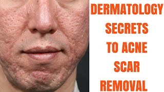 Acne scar treatments ULTIMATE GUIDE [upl. by Luemas]