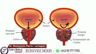 Chirurgie MiniInvasive en Urologie [upl. by Nnod]