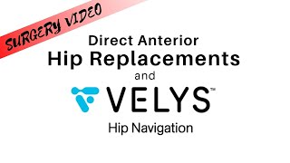 VELYS Hip Navigation and DePuy Direct Anterior Advantage Hip Replacement [upl. by Ariad]