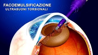 Cataratta terapia chirurgica con ultrasuoni torsionali wwwoculisticaTVit [upl. by Mcneely]