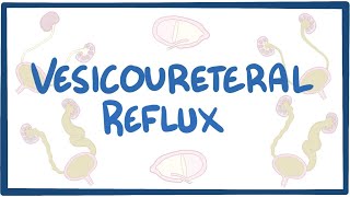 Vesicoureteral reflux  causes symptoms diagnosis treatment pathology [upl. by Tyson]