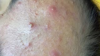 inflamed forehead and cheek acne  dermacool 0217 [upl. by Nide540]