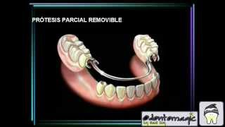 PROTESIS REMOVIBLE PARCIAL Y TOTAL [upl. by Nerra36]