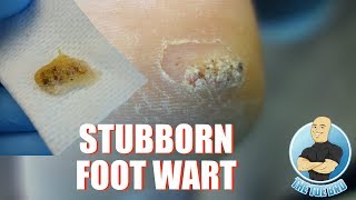 HOW TO TREAT DIFFICULT PLANTAR WARTS REMOVAL  FOOT HEALTH MONTH 2018 9 [upl. by Nitsuj171]