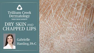 How to treat dry skin and chapped lips [upl. by Stanleigh]