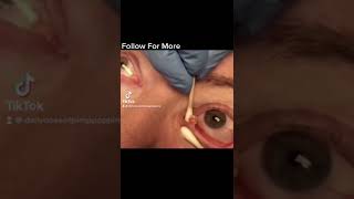 pimple popping 2022 new blackheads on nose pimple popping tiktok SHORT1 [upl. by Aronson]