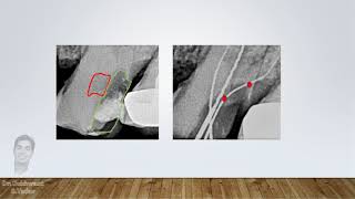 Problem solving in access opening during RCT [upl. by Everard]