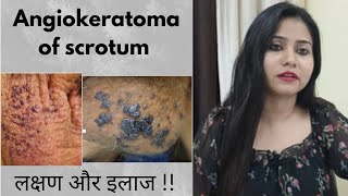 Angiokeratoma of fordyceScrotum homeopathic treatment  Angiokeratoma symptomscauses amp medicine [upl. by Ladnar]