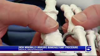 Medical Breakthrough New minimallyinvasive bunionectomy procedure [upl. by Connell]