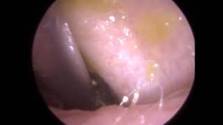 271  Ear Wax Removal using Jobson Horne Zoellner Sucker and Sodium Bicarbonate [upl. by Bartolemo]