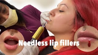 Needleless lip fillers  1st session of lip fillers [upl. by Cutcheon598]