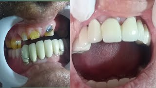 12 unit of dental bridge after before [upl. by Sedlik]