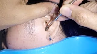 Removing Huge Earwax Stuck in Womans Ear [upl. by Alan]