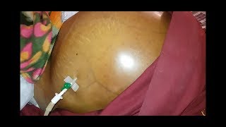 Ascites Fluid Tapping Procedure  Percentesis [upl. by Weisler973]