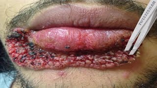 Worst Lip Pimples on YouTube [upl. by Droffig]