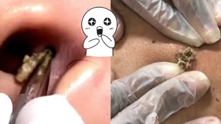 Ultimate Compilation Satisfying Blackhead Removal and Acne Treatment Highlights [upl. by Lettie]