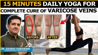 EXERCISE FOR VARICOSE VEINS  YOGA FOR VARICOSE VEINS  Dr Gaurav Gangwani [upl. by Moira]