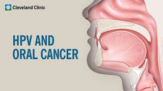 What Is HPVRelated Oral Cancer [upl. by Neelon]