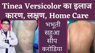 Tinea Versicolar Treatment  भभूतीसीपसहुआकरोडिया का इलाज  Pityriasis Versicolor  In Hindi [upl. by Crim]