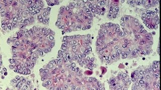 Thyroid Neoplasms  Pathology mini tutorial [upl. by Carl]