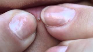 Lip Blackhead [upl. by Donohue]