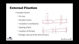 Biomechanics of fractures and fixation  3 of 4 [upl. by Yffat]