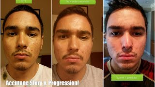 Is Accutane worth it My Story [upl. by Retep687]