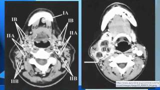 Radiology  Cervical Lymph Nodes  Head and Neck [upl. by Mead]