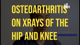 Osteoarthritis on Xrays of Hip and Knee [upl. by Yrram]